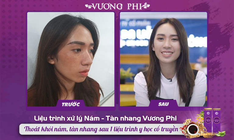 Hình ảnh khác biệt của Thanh Vân trước và sau khi xử lý nám, tàn nhang bằng Vương Phi