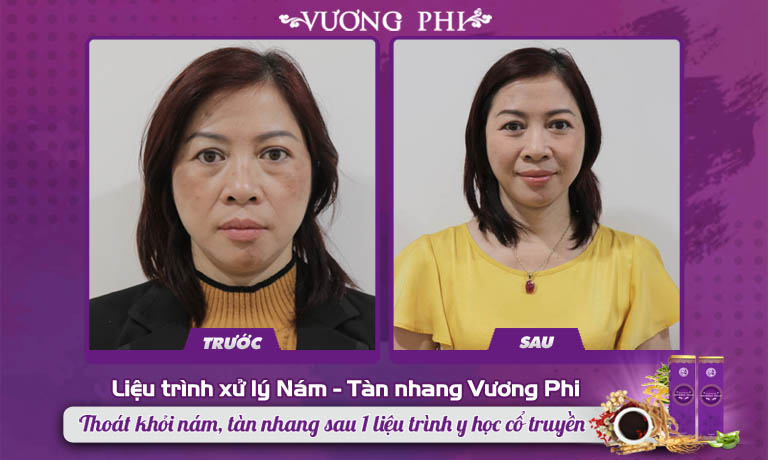 Cô Kim Hoa không thể tin được mình còn có thể lấy lại được làn da sáng ở độ tuổi U50