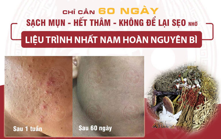 Làn da của anh Nguyễn Văn Hiện cải thiện rõ rệt chỉ sau 60 ngày dùng Nhất Nam Hoàn Nguyên Bì