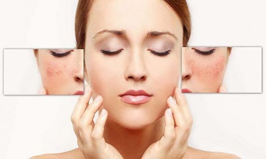 Phân loại nám da mặt dưới góc nhìn chuyên gia và giải pháp xử lý an toàn cho làn da