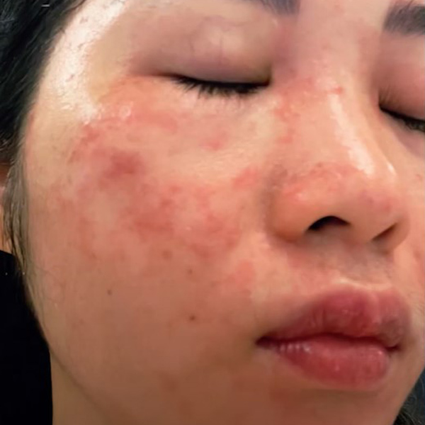 Làn da của chị Trang tổn thương nghiêm trọng sau khi sử dụng laser xử lý nám, tàn nhang