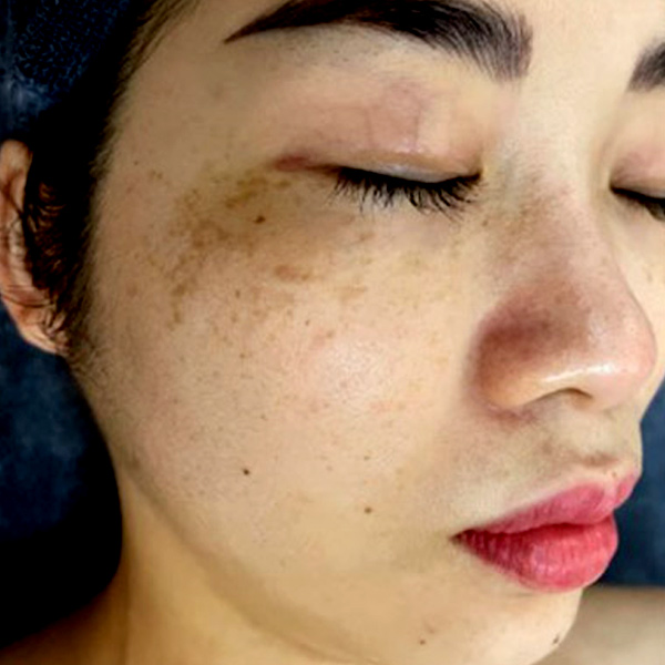 Tình trạng tàn nhang trên da của chị Trang trở nên nghiêm trọng hơn sau khi sinh con