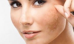 [CHI TIẾT] Thông tin về nám da và cách cải thiện sắc tố giúp da sáng đẹp, rạng rỡ